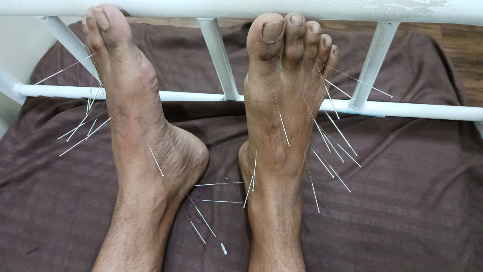 Best Dry Needling Treatment for Foot Pain in Pune